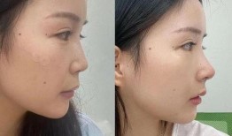 杭州整形爆料事件视频,揭秘美容行业潜规则与真实案例